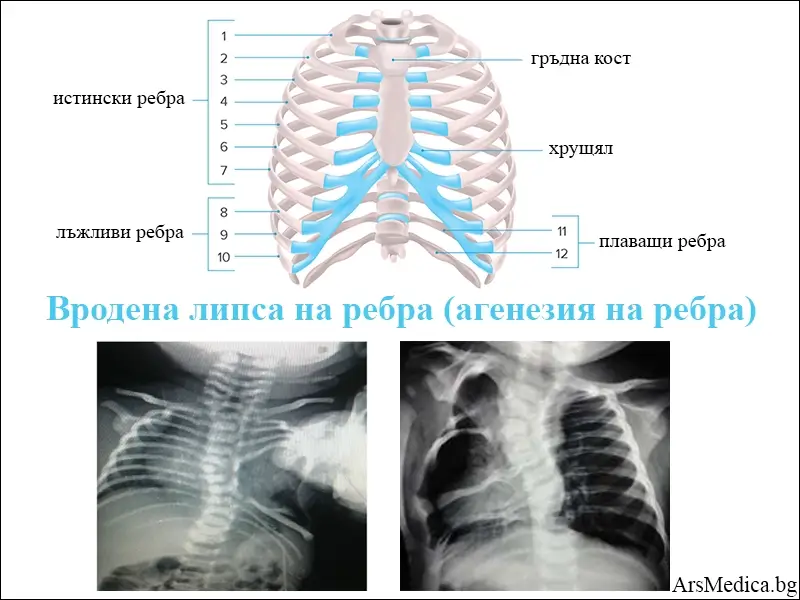 Вродена липса на ребра (агенезия на ребра)
