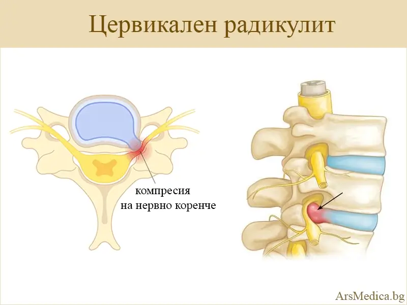 cervikalen-radikulit цервикален радикулит