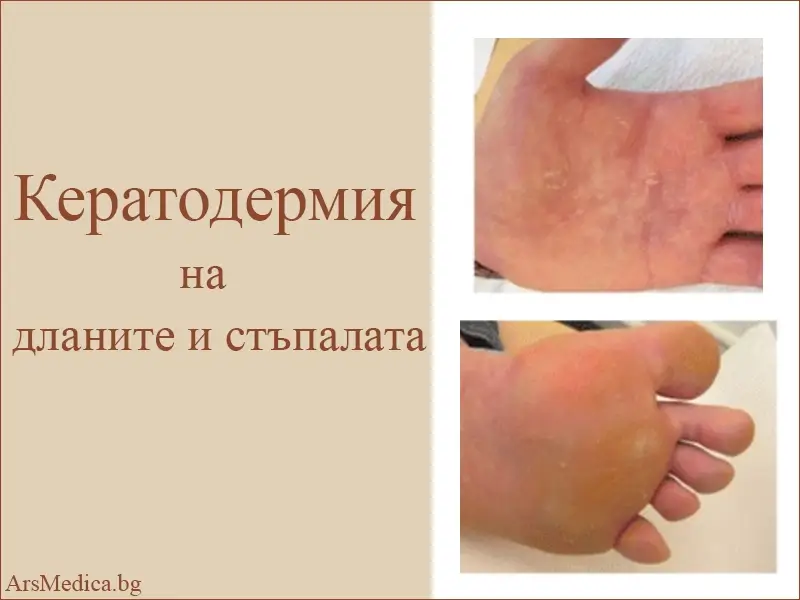 Кератодермия на дланите и стъпалата