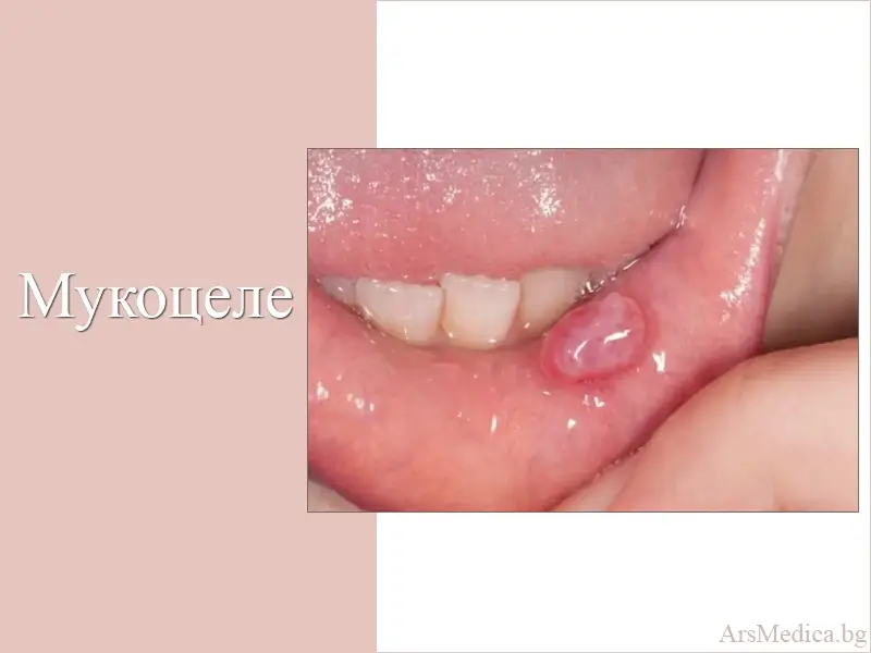 Мукоцеле – киста на малките слюнчени жлези