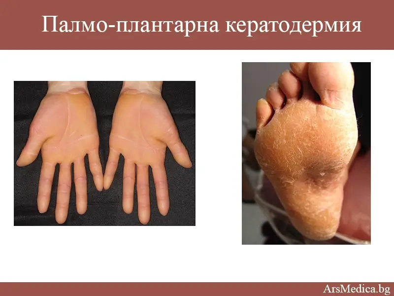 Палмо-плантарна кератодермия (кератоза на длани и стъпала)