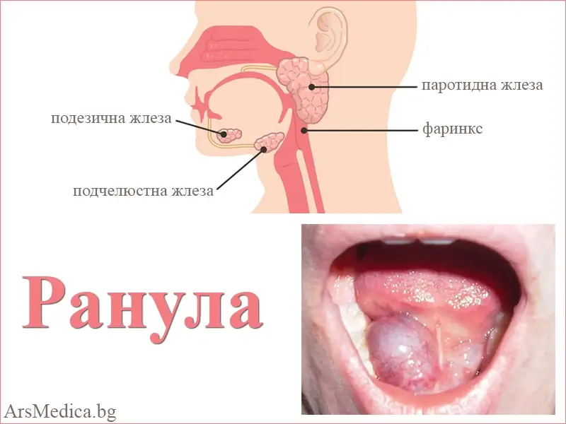Ранула – видове, причини, симптоми, лечение