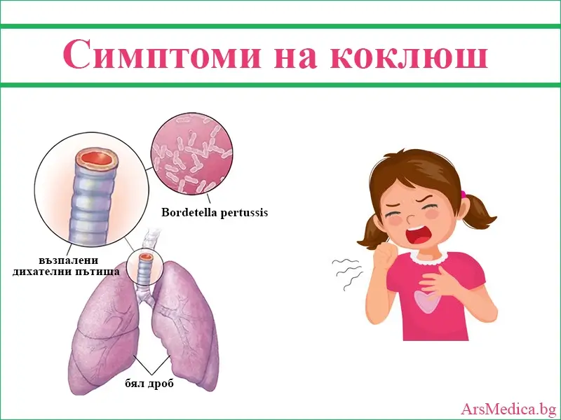 Ключови симптоми на коклюш при деца и възрастни