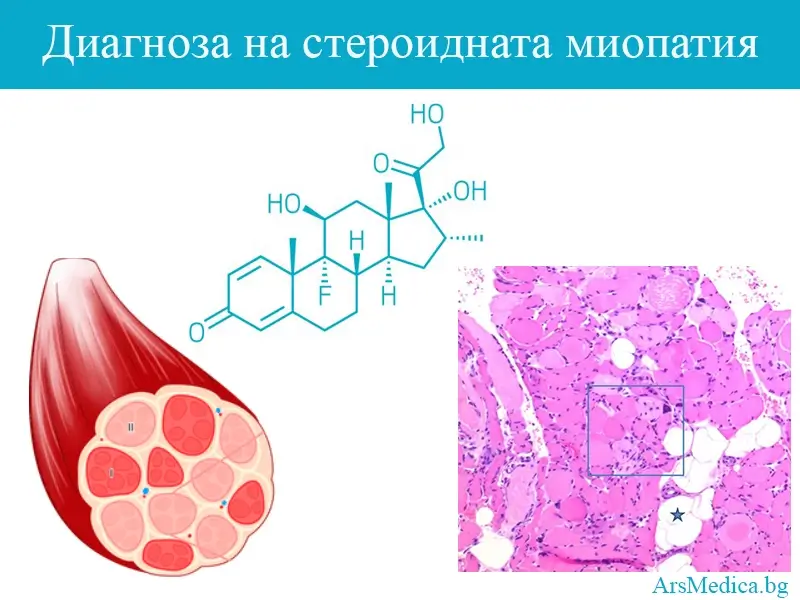 diagnoza-steroidna-miopatia миопатия