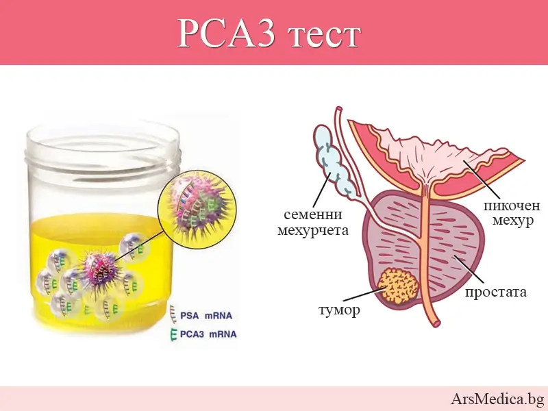 PCA3 тест – биомаркер за оценка на риска от рак на простатата