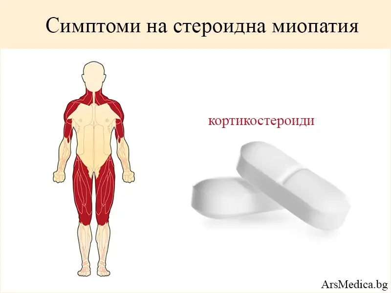 steroidna-miopatia стероидна миопатия