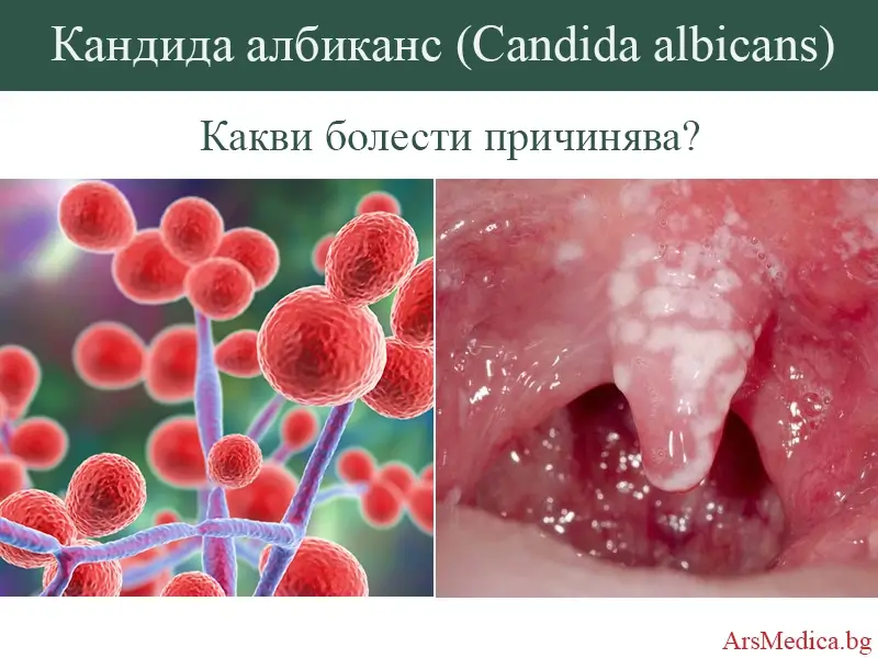 Кандида албиканс (C. albicans) – какви инфекции причинява?