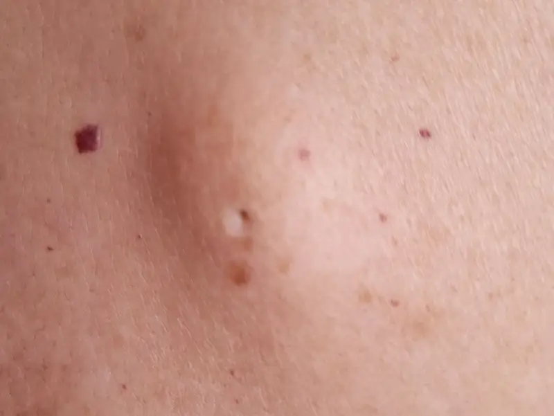 Епидермоидна киста (епидермална киста)