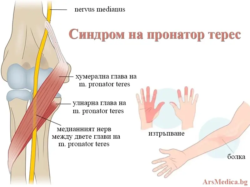 sindrom-na-pronator-teres синдром на пронатор терес