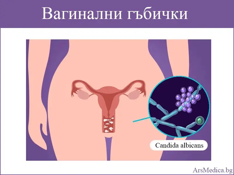 Вагинални гъбички (вагинална кандидоза)