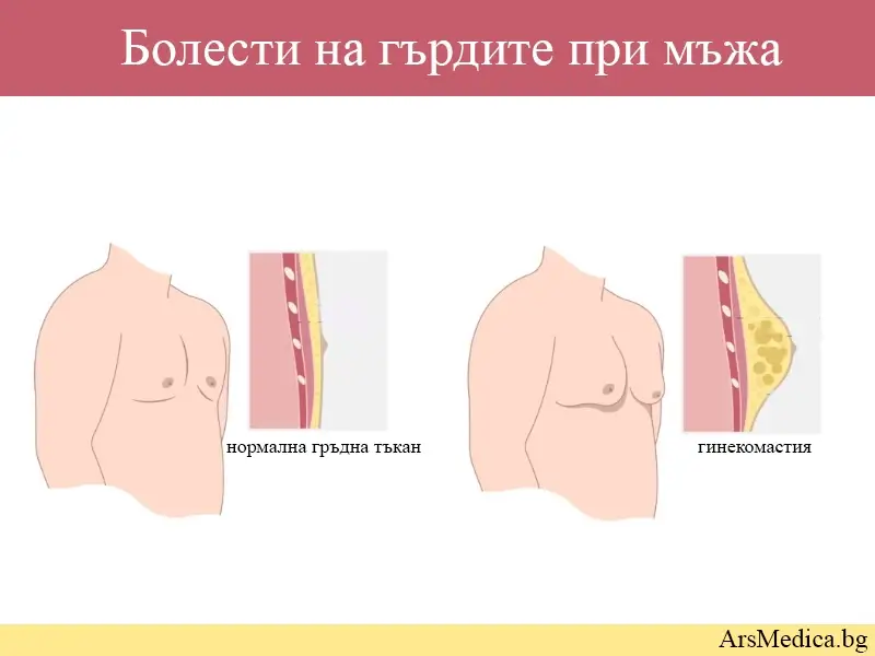 Болести на гърдите при мъжа