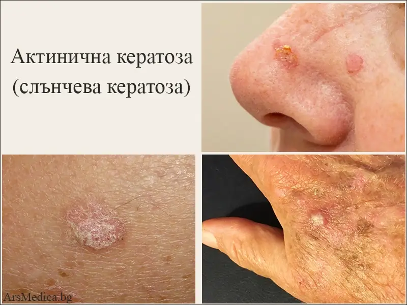 Актинична кератоза (слънчева кератоза)