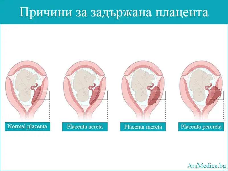 Задържана плацента – причини