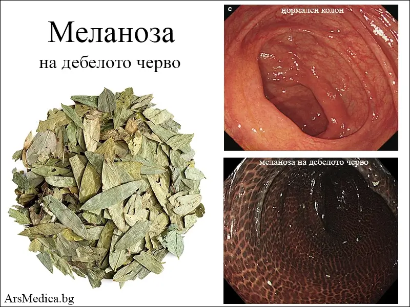 Меланоза на дебелото черво – при прием на сена