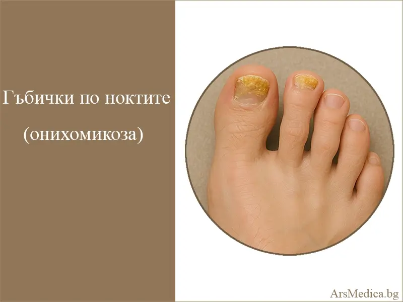 gabichki-po-nokktite гъбички по ноктите